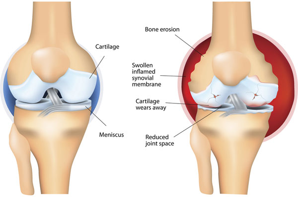 Bolečine v kolkih in kolenih