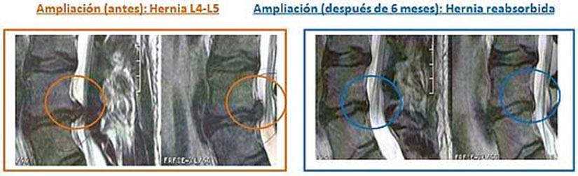 Hernija diska pred in po uporabi AtlasPROfilax metode