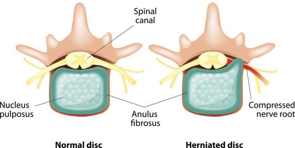Hernija diska